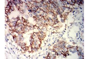 Immunohistochemical analysis of paraffin-embedded ovarian cancer tissues using NCAM1 mouse mAb with DAB staining. (CD56 antibody)
