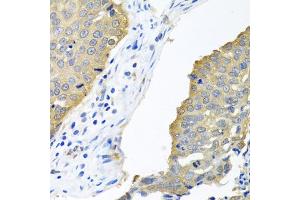Immunohistochemistry of paraffin-embedded human lung cancer using EIF4E antibody (ABIN5971189) at dilution of 1/100 (40x lens). (EIF4E antibody)
