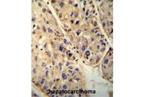 ABCD1 antibody (Center) immunohistochemistry analysis in formalin fixed and paraffin embedded human hepatocarcinoma followed by peroxidase conjugation of the secondary antibody and DAB staining. (ABCD1 antibody  (Middle Region))