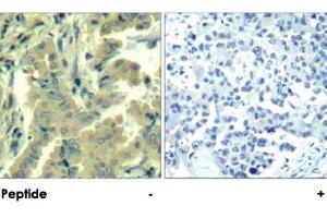 Immunohistochemical analysis of paraffin-embedded human lung carcinoma tissue using PLCG2 polyclonal antibody . (Phospholipase C gamma 2 antibody  (Tyr1217))