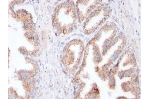 Formalin-fixed, paraffin-embedded human Prostate Carcinoma stained with FOLH1 Rabbit Recombinant Monoclonal Antibody (FOLH1/3149R). (Recombinant PSMA antibody  (AA 232-433))