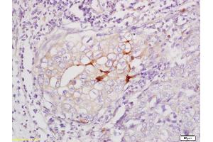 Formalin-fixed and paraffin embedded human cervical carcinoma labeled with Anti-Phospho-Beta-Catenin(Ser33/37) Polyclonal Antibody, Unconjugated (ABIN683893) at 1:200 followed by conjugation to the secondary antibody and DAB staining (beta Catenin antibody  (pSer33, pSer37))