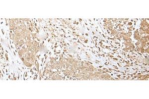 Immunohistochemistry of paraffin-embedded Human esophagus cancer tissue using ZKSCAN3 Polyclonal Antibody at dilution of 1:50(x200) (ZKSCAN3 antibody)