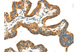 The image on the left is immunohistochemistry of paraffin-embedded Human thyroid cancer tissue using ABIN7192934(TRPV5 Antibody) at dilution 1/25, on the right is treated with synthetic peptide. (TRPV5 antibody)