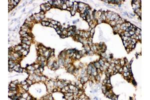 Anti- TRAP1 Picoband antibody, IHC(P) IHC(P): Human Intestinal Cancer Tissue (TRAP1 antibody  (AA 571-704))