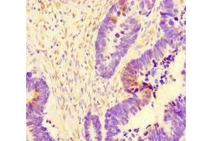 Immunohistochemistry of paraffin-embedded human ovarian cancer using ABIN7171154 at dilution of 1:100 (SYT1 antibody  (AA 301-523))