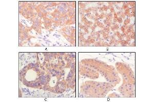 Immunohistochemical analysis of paraffin-embedded human lung squamous cell carcinoma (A),normal hepatocyte (B), colon adenocacinoma, normal stomach tissue (D), showing cytoplasmic and membrane localization using CK antibody with DAB staining. (pan Keratin antibody)