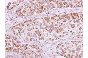 IHC-P Image PSKH1 antibody detects PSKH1 protein at cytooplasm and membrane on human liver carcinoma by immunohistochemical analysis. (PSKH1 antibody)