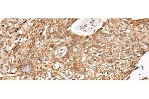 Immunohistochemistry of paraffin-embedded Human lung cancer tissue using C14orf169 Polyclonal Antibody at dilution of 1:45(x200)