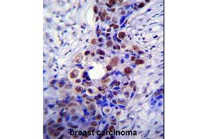 HDAC2 Antibody (C-term) (ABIN6242378 and ABIN6577318) immunohistochemistry analysis in formalin fixed and paraffin embedded human breast carcinoma followed by peroxidase conjugation of the secondary antibody and DAB staining. (HDAC2 antibody  (C-Term))