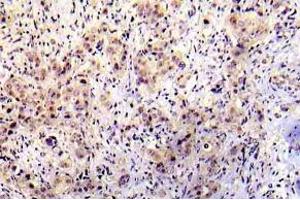 Immunohistochemistry (IHC) analyzes of p-P53 antibody in paraffin-embedded human breast carcinoma tissue. (p53 antibody  (pSer20))