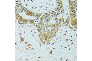 Immunohistochemistry of paraffin-embedded human breast cancer using METTL13 antibody. (METTL13 antibody)