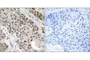 Immunohistochemistry analysis of paraffin-embedded human lung carcinoma tissue, using TNNI3K Antibody. (TNNI3K antibody  (AA 301-350))