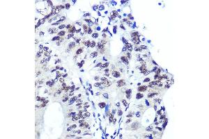 Immunohistochemistry of paraffin-embedded human colon carcinoma using Ku70 Rabbit mAb (ABIN7271407) at dilution of 1:100 (40x lens). (XRCC6 antibody)