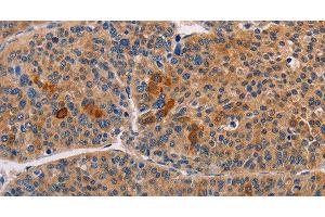 Immunohistochemistry of paraffin-embedded Human liver cancer using ALDH3A1 Polyclonal Antibody at dilution of 1:55 (ALDH3A1 antibody)