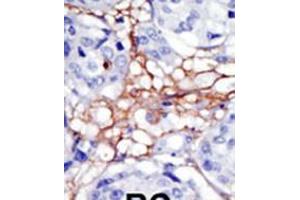 Formalin-fixed and paraffin-embedded human cancer tissue reacted with the primary antibody, which was peroxidase-conjugated to the secondary antibody, followed by DAB staining. (PIP4K2A antibody  (N-Term))