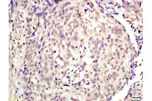 Formalin-fixed and paraffin embedded human laryngeal tissue labeled with Rabbit Anti-KDM5A Polyclonal Antibody, Unconjugated (ABIN2177121) at 1:200 followed by conjugation to the secondary antibody and DAB staining (KDM5A antibody  (AA 101-200))