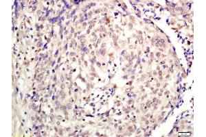 Formalin-fixed and paraffin embedded human laryngeal tissue labeled with Rabbit Anti-KDM5A Polyclonal Antibody, Unconjugated (ABIN2177121) at 1:200 followed by conjugation to the secondary antibody and DAB staining