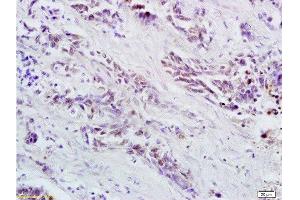 Formalin-fixed and paraffin embedded human colorectal cancer labeled with Anti OCT4B-190 Polyclonal Antibody, Unconjugated  at 1:200 followed by conjugation to the secondary antibody and DAB staining (Oct-4BOCT4B-190NT (AA 201-300) antibody)