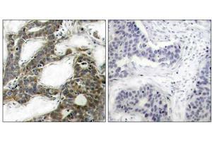 Immunohistochemical analysis of paraffin-embedded human breast carcinoma tissue, using β-Catenin (Ab-33) antibody (E021211). (beta Catenin antibody)