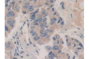Detection of CHGB in Human Breast cancer Tissue using Polyclonal Antibody to Chromogranin B (CHGB) (CHGB antibody  (AA 496-669))