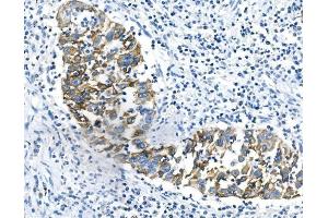 IHC analysis of Cytokeratin 18 using anti-Cytokeratin 18 antibody (ABIN7600573). (Cytokeratin 18 antibody  (AA 204-430))