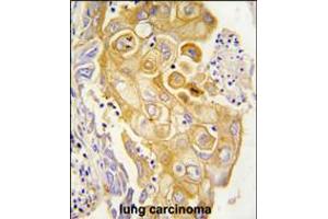 Formalin-fixed and paraffin-embedded human lung carcinoma tissue reacted with CYP8A1 antibody , which was peroxidase-conjugated to the secondary antibody, followed by DAB staining.