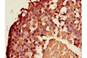 Immunohistochemistry of paraffin-embedded human breast cancer using ABIN7143672 at dilution of 1:100 (ALDH3B2 antibody  (AA 57-311))