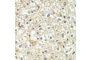Immunohistochemistry of paraffin-embedded human liver injury using LMNB2 Antibody (ABIN5973877) at dilution of 1/200 (40x lens). (Lamin B2 antibody)