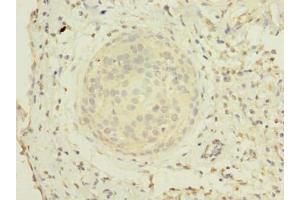 Immunohistochemistry of paraffin-embedded human cervical cancer using ABIN7176663 at dilution of 1:100 (ZHX1-C8ORF76 Readthrough (ZHX1-C8ORF76) (AA 1-292), (Isoform 2) antibody)
