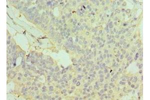 Immunohistochemistry of paraffin-embedded human endometrial cancer using ABIN7154113 at dilution of 1:100 (GSTO2 antibody  (AA 124-243))