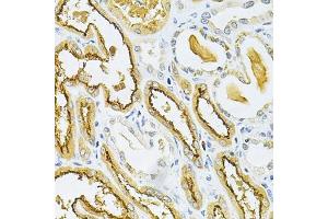 Immunohistochemistry of paraffin-embedded human kidney cancer using GLRX Antibody (ABIN6127980, ABIN6141147, ABIN6141149 and ABIN6220940) at dilution of 1:200 (40x lens).