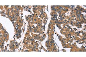 Immunohistochemistry of paraffin-embedded Human breast cancer tissue using BNIP2 Polyclonal Antibody at dilution 1:50 (BNIP2 antibody)