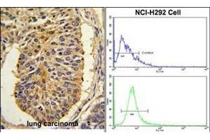 (LEFT)Formalin-fixed and paraffin-embedded human lung carcinoma with CER1 Antibody (N-term), which was peroxidase-conjugated to the secondary antibody, followed by DAB staining. (CER1 antibody  (N-Term))