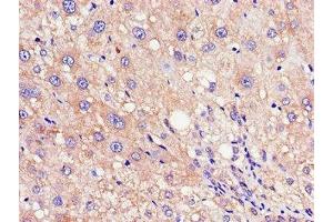 Immunohistochemistry of paraffin-embedded human liver cancer using ABIN7168030 at dilution of 1:100 (RND3 antibody  (AA 152-239))