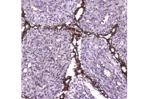 IHC testing of FFPE human breast cancer tissue with Glutathione Reductase antibody at 1ug/ml. (Glutathione Reductase antibody)