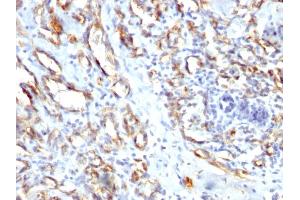 Formalin-fixed, paraffin-embedded human Angiosarcoma stained with CD31 Rabbit Polyclonal Antibody. (CD31 antibody)