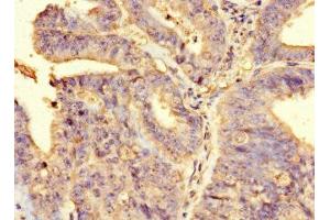 Immunohistochemistry of paraffin-embedded human endometrial cancer using ABIN7167899 at dilution of 1:100 (RIPOR2 antibody  (AA 1-250))