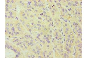 Immunohistochemistry of paraffin-embedded human liver cancer using ABIN7149265 at dilution of 1:100 (CYP3A5 antibody  (AA 233-502))