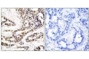 Immunohistochemical analysis of paraffin-embedded human breast carcinoma tissue using CREB (phospho-Ser129) antibody (E011273). (CREB1 antibody  (pSer129))