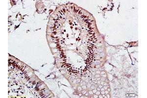 Formalin-fixed and adjacent noncancerous of human colon tissue labeled with Anti-Mel18/ZNF144 Polyclonal Antibody, Unconjugated  at 1:200 followed by conjugation to the secondary antibody and DAB staining (PCGF2 antibody  (AA 170-210))