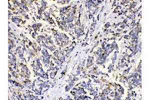 MUT was detected in paraffin-embedded sections of human mammary cancer tissues using rabbit anti- MUT Antigen Affinity purified polyclonal antibody (Catalog # ) at 1 µg/mL. (MUT antibody  (N-Term))