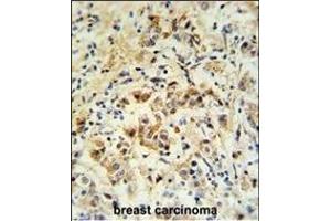 小鼠BID抗体（S61）（ABIN388100和ABIN2846184）在福尔马林固定和石蜡包埋的人乳腺癌中进行IHC分析，然后进行二级抗体的过氧化物酶结合和DAB染色。（BID抗体（AA 39-68））