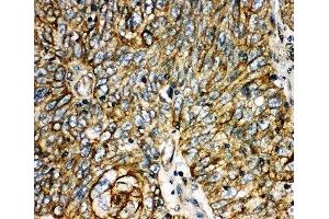 IHC-P: Aquaporin 6 antibody testing of human lung cancer tissue