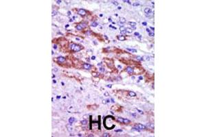 Formalin-fixed and paraffin-embedded human hepatocellular carcinoma tissue reacted with CSNK1D polyclonal antibody  , which was peroxidase-conjugated to the secondary antibody, followed by DAB staining. (Casein Kinase 1 delta antibody  (C-Term))