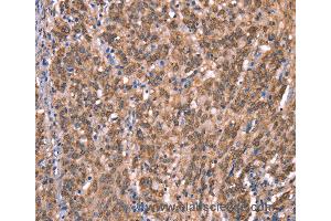 Immunohistochemistry of Human liver cancer using GCSAM Polyclonal Antibody at dilution of 1:40 (GCET2 antibody)