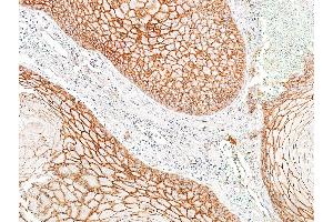Immunohistochemistry (IHC) image for anti-Cadherin 1, Type 1, E-Cadherin (Epithelial) (CDH1) (AA 155-707) antibody (ABIN7454024)