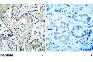 Immunohistochemical analysis of paraffin-embedded human breast carcinoma, using MAP2K3 polyclonal antibody . (MAP2K3 antibody  (Ser207))