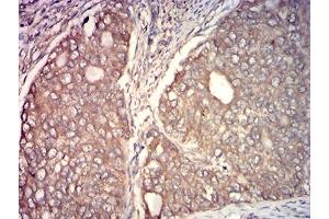 Immunohistochemical analysis of paraffin-embedded cervical cancer tissues using CAPN1 mouse mAb with DAB staining. (CAPNL1 antibody  (AA 501-714))