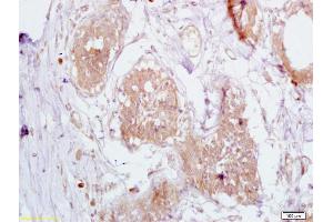 Formalin-fixed and paraffin embedded human breast carcinoma labeled with Anti-CD168/RHAMM Polyclonal Antibody, Unconjugated (ABIN1386755) at 1:200 followed by conjugation to the secondary antibody and DAB staining (HMMR antibody  (AA 51-150))